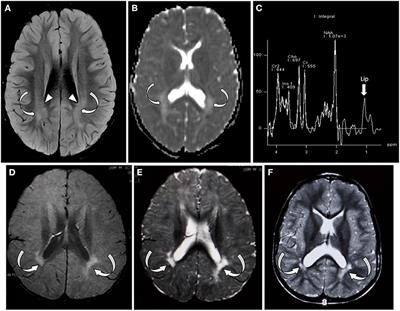 Case Report: SATB2-Associated Syndrome Overlapping With Clinical Mitochondrial Disease Presentation: Report of Two Cases